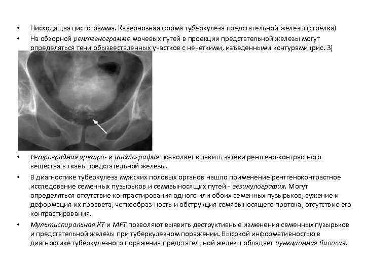  • • Нисходящая цистограмма. Кавернозная форма туберкулеза предстательной железы (стрелка) На обзорной рентгенограмме