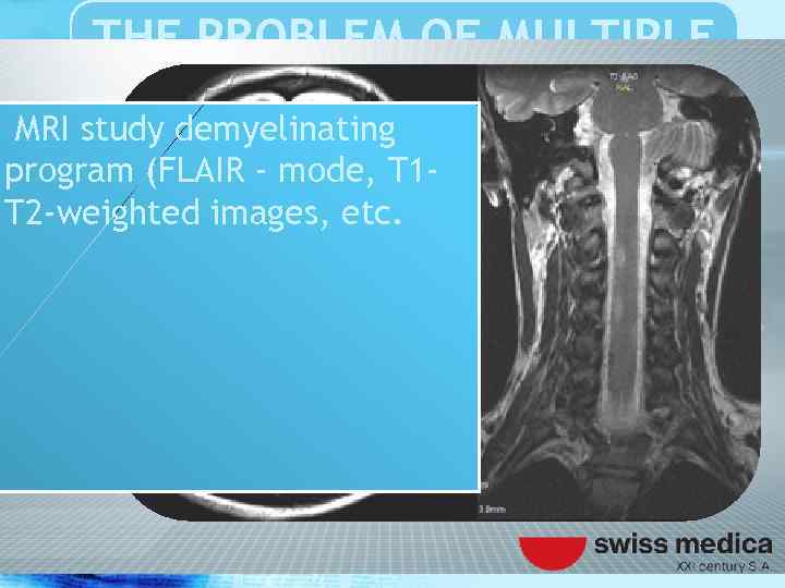 THE PROBLEM OF MULTIPLE SCLEROSIS MRI study demyelinating program (FLAIR - mode, T 1