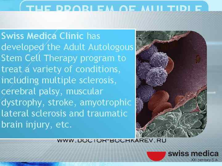 THE PROBLEM OF MULTIPLE SCLEROSIS Swiss Medica Clinic has developed the Adult Autologous Stem
