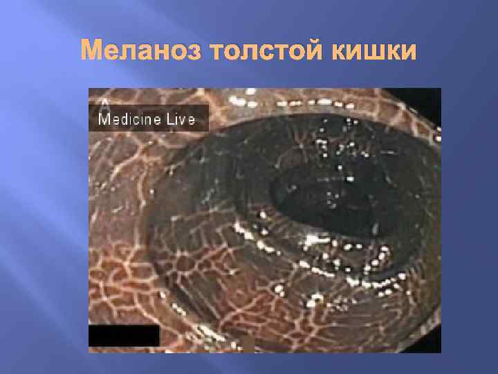 Меланоз толстой кишки 