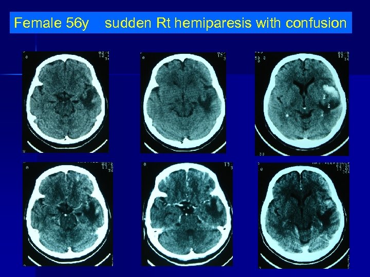 Female 56 y sudden Rt hemiparesis with confusion 