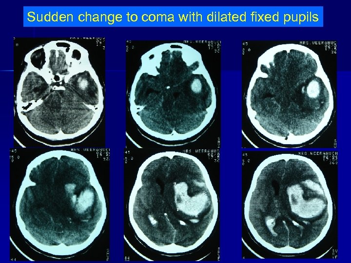 Sudden change to coma with dilated fixed pupils 