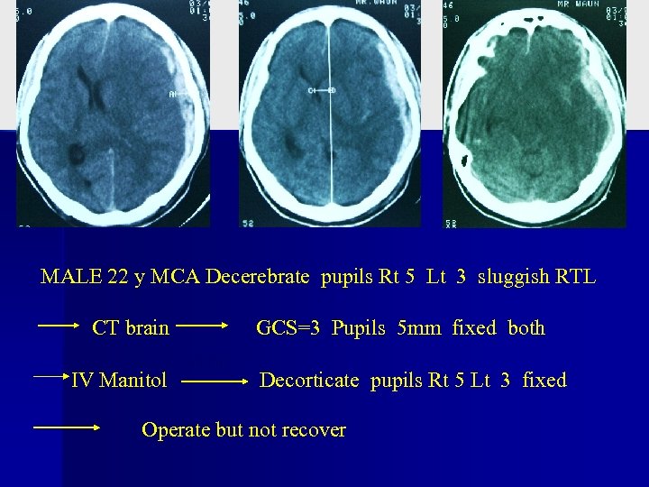MALE 22 y MCA Decerebrate pupils Rt 5 Lt 3 sluggish RTL CT brain