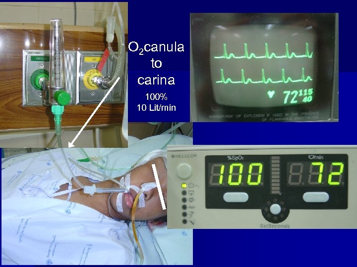 O 2 canula to carina 100% 10 Lit/min 
