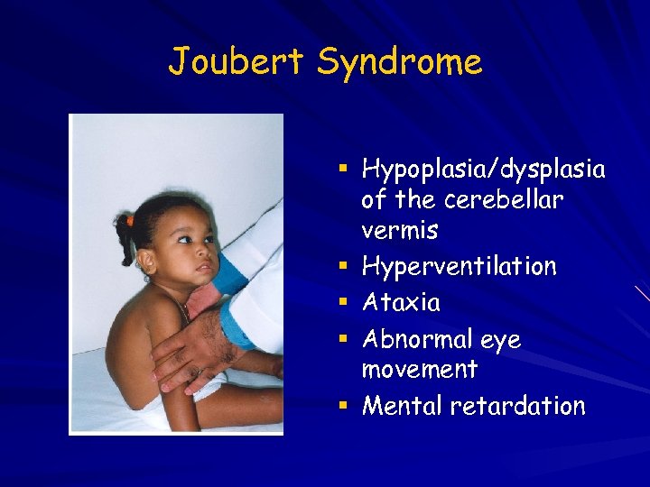 Joubert Syndrome Hypoplasia/dysplasia of the cerebellar vermis Hyperventilation Ataxia Abnormal eye movement Mental retardation