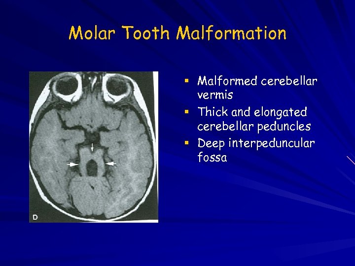 Molar Tooth Malformation Malformed cerebellar vermis Thick and elongated cerebellar peduncles Deep interpeduncular fossa