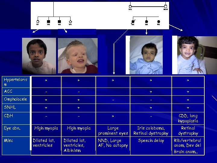 Hyperteloris m + + ACC - - Omphalocele + + SNHL + + CDH