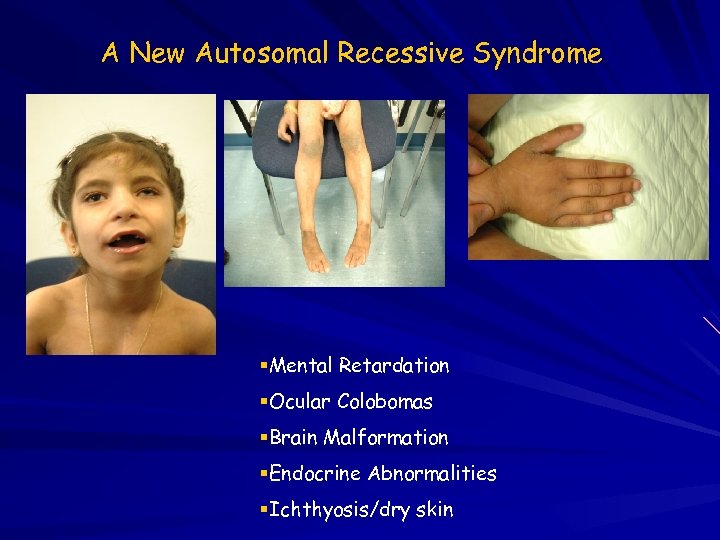 A New Autosomal Recessive Syndrome Mental Retardation Ocular Colobomas Brain Malformation Endocrine Abnormalities Ichthyosis/dry