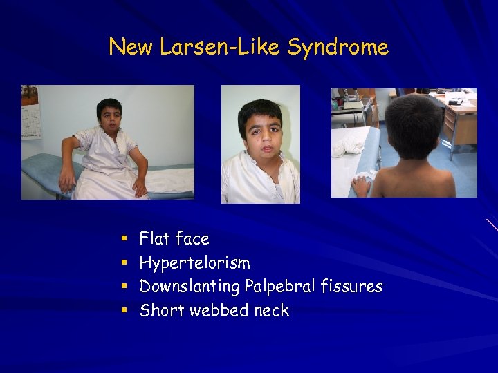 New Larsen-Like Syndrome Flat face Hypertelorism Downslanting Palpebral fissures Short webbed neck 