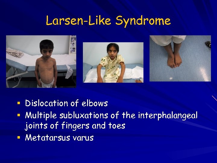 Larsen-Like Syndrome Dislocation of elbows Multiple subluxations of the interphalangeal joints of fingers and