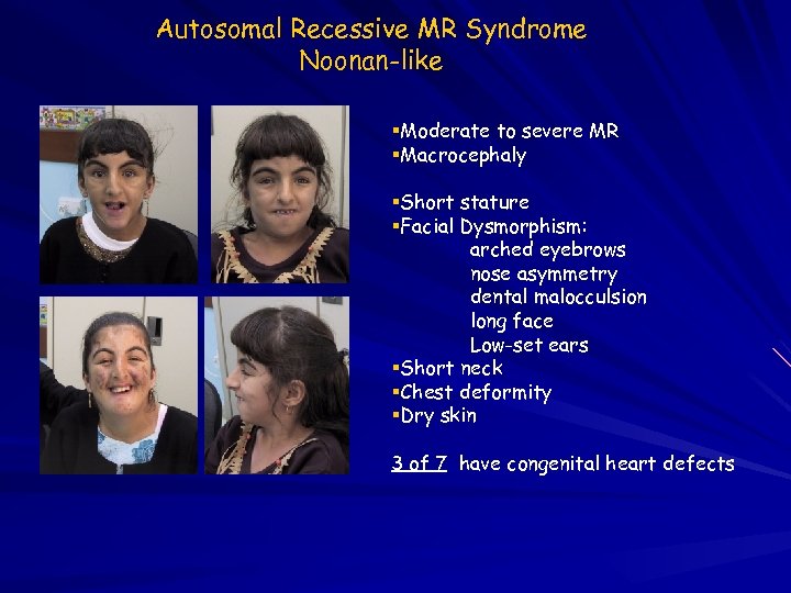 Autosomal Recessive MR Syndrome Noonan-like Moderate to severe MR Macrocephaly Short stature Facial Dysmorphism: