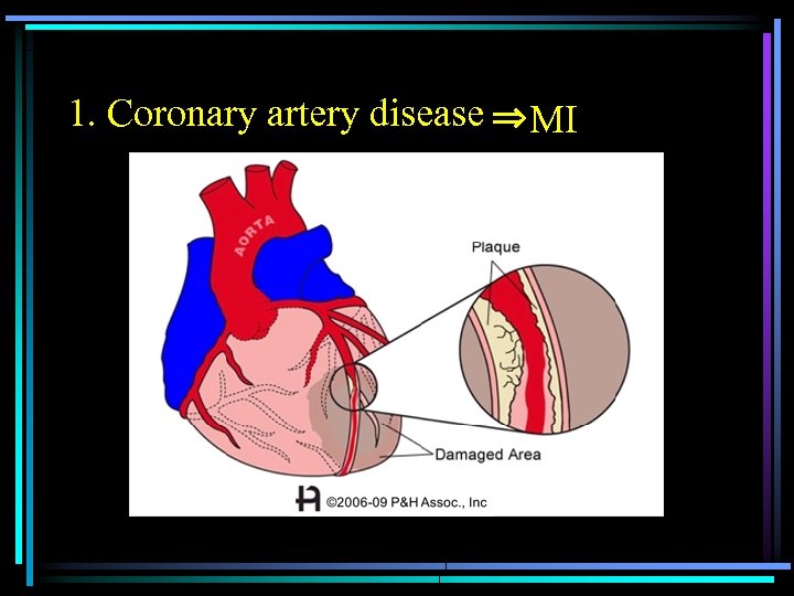 1. Coronary artery disease 　　　　　　　 ⇒MI 