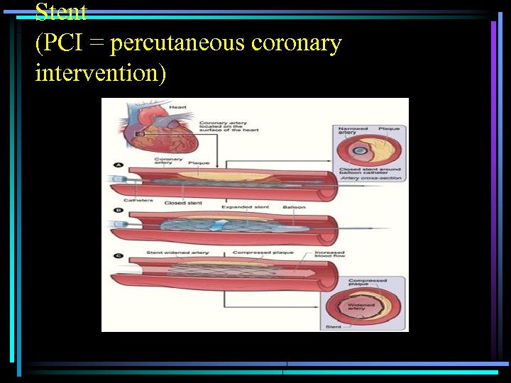 Stent (PCI = percutaneous coronary intervention) 