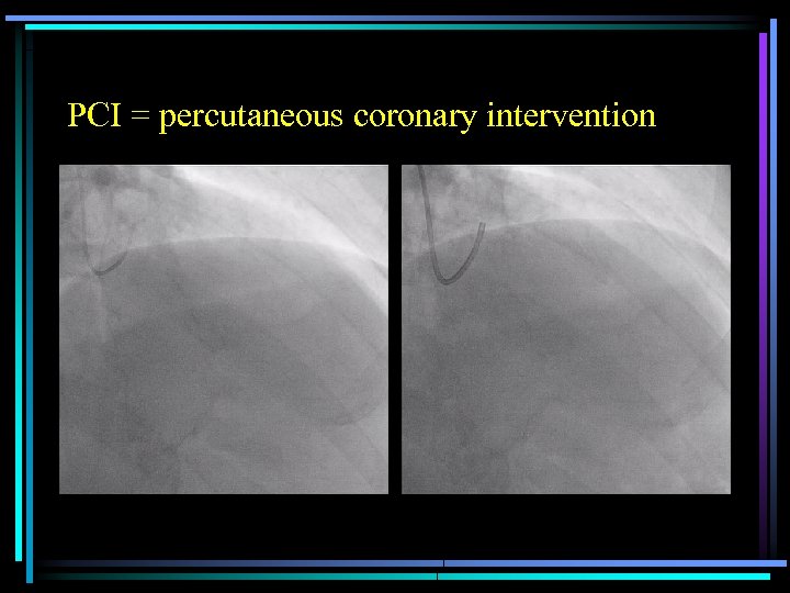 PCI = percutaneous coronary intervention 