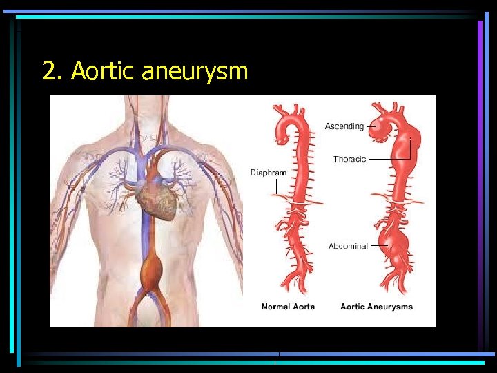 2. Aortic aneurysm 