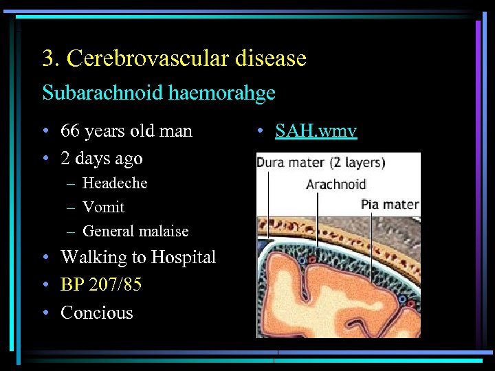 3. Cerebrovascular disease Subarachnoid haemorahge • 66 years old man • 2 days ago
