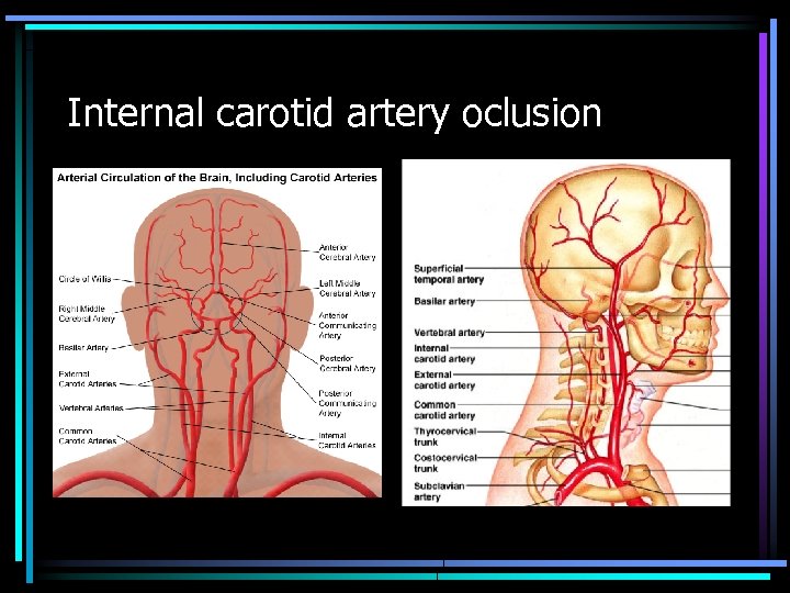 Internal carotid artery oclusion 