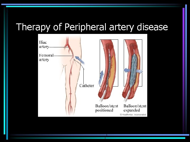 Therapy of Peripheral artery disease 