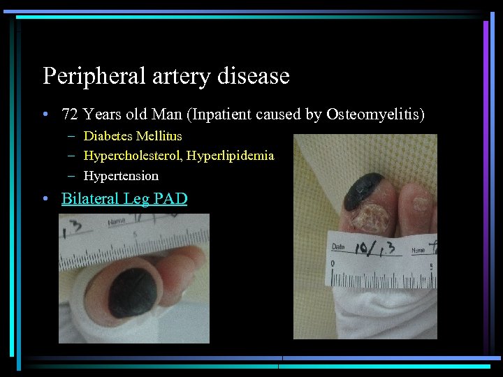 Peripheral artery disease • 72 Years old Man (Inpatient caused by Osteomyelitis) – Diabetes