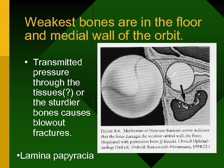 Weakest bones are in the floor and medial wall of the orbit. • Transmitted