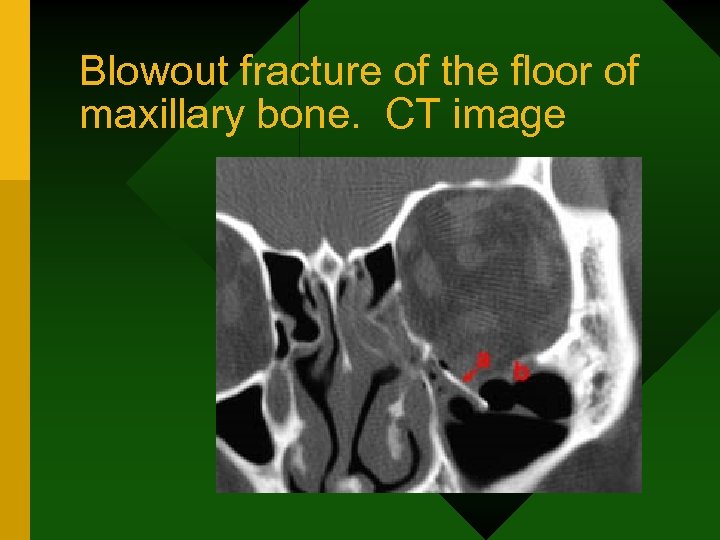 Blowout fracture of the floor of maxillary bone. CT image 