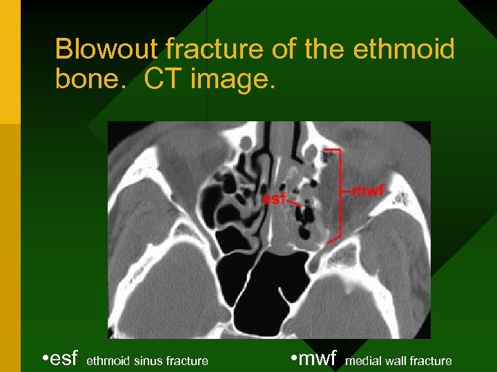 Blowout fracture of the ethmoid bone. CT image. • esf ethmoid sinus fracture •