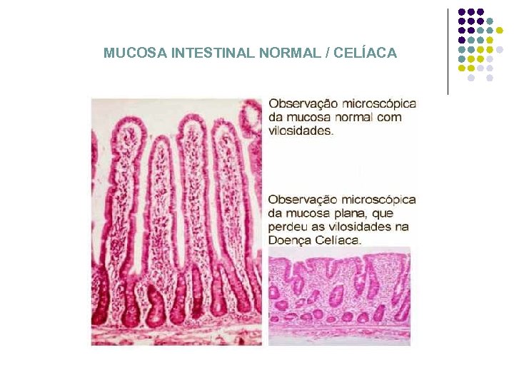  MUCOSA INTESTINAL NORMAL / CELÍACA 