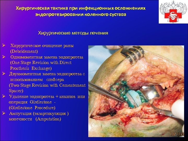 Хирургическая тактика при инфекционных осложнениях эндопротезирования коленного сустава Хирургические методы лечения Ø Хирургическое очищение