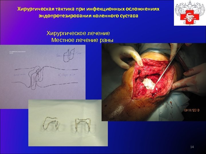 Хирургическая тактика при инфекционных осложнениях эндопротезирования коленного сустава Хирургическое лечение Местное лечение раны 14