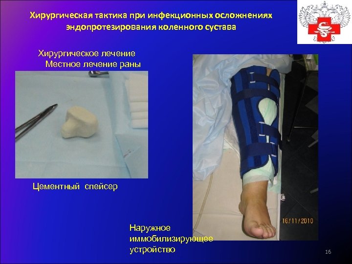 Хирургическая тактика при инфекционных осложнениях эндопротезирования коленного сустава Хирургическое лечение Местное лечение раны Цементный
