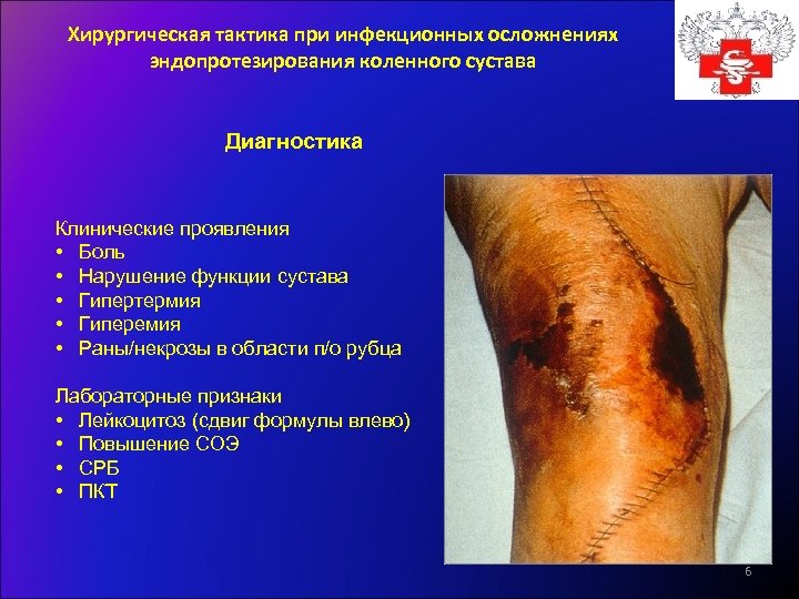 Хирургическая тактика при инфекционных осложнениях эндопротезирования коленного сустава Диагностика Клинические проявления • Боль •