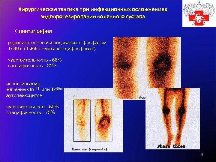 Хирургическая тактика при инфекционных осложнениях эндопротезирования коленного сустава Сцинтиграфия радиоизотопное исследование с фосфатом Tc
