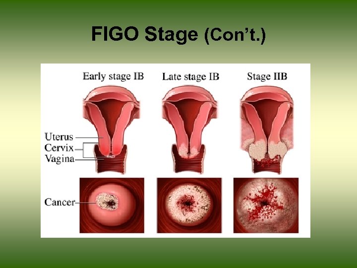 FIGO Stage (Con’t. ) 