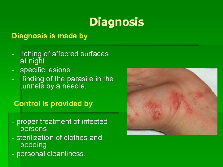 Diagnosis is made by - itching of affected surfaces at night - specific lesions