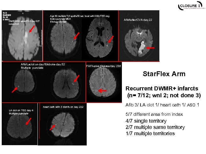 DM/CABG/valve/CVA day 627 index. ACA Age 60 multiple TIA spells/30 sec focal with DW+/TEE