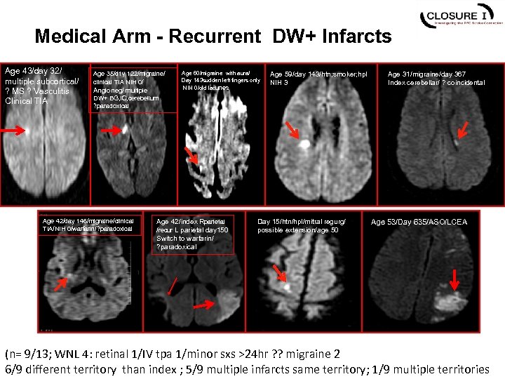 Medical Arm - Recurrent DW+ Infarcts Age 43/day 32/ multiple subcortical/ ? MS ?