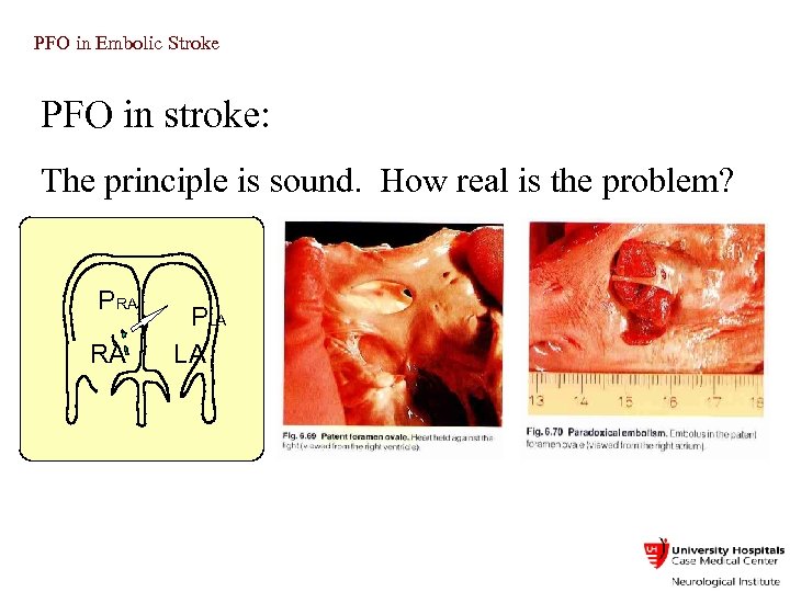 PFO in Embolic Stroke PFO in stroke: The principle is sound. How real is