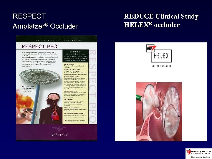 RESPECT Amplatzer® Occluder REDUCE Clinical Study HELEXR occluder 