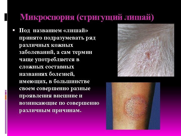 Микроспория (стригущий лишай) Под названием «лишай» принято подразумевать ряд различных кожных заболеваний, а сам