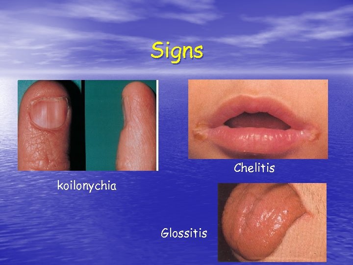 Signs Chelitis koilonychia Glossitis 