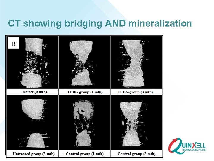 CT showing bridging AND mineralization 