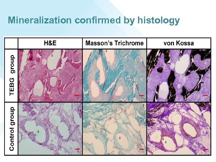 Mineralization confirmed by histology S S S 