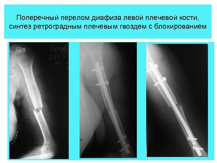 Поперечный перелом диафиза левой плечевой кости, синтез ретроградным плечевым гвоздем с блокированием 