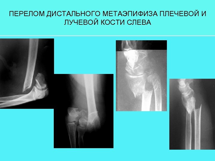 ПЕРЕЛОМ ДИСТАЛЬНОГО МЕТАЭПИФИЗА ПЛЕЧЕВОЙ И ЛУЧЕВОЙ КОСТИ СЛЕВА 