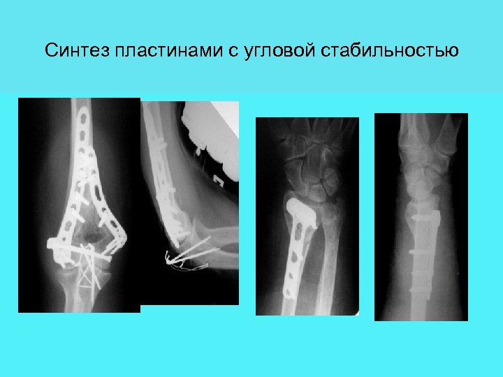 Синтез пластинами с угловой стабильностью 