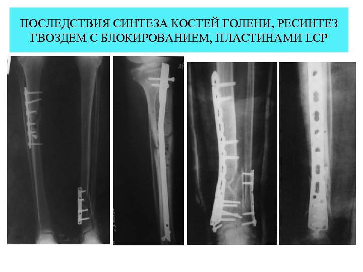ПОСЛЕДСТВИЯ СИНТЕЗА КОСТЕЙ ГОЛЕНИ, РЕСИНТЕЗ ГВОЗДЕМ С БЛОКИРОВАНИЕМ, ПЛАСТИНАМИ LСP 