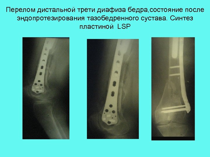 Перелом дистальной трети диафиза бедра, состояние после эндопротезирования тазобедренного сустава. Синтез пластиной LSP 