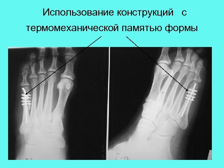 Использование конструкций с термомеханической памятью формы 