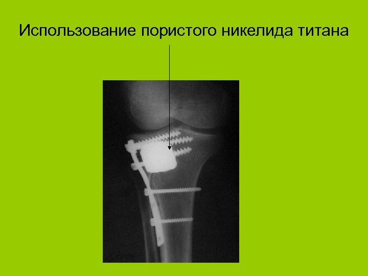 Использование пористого никелида титана 