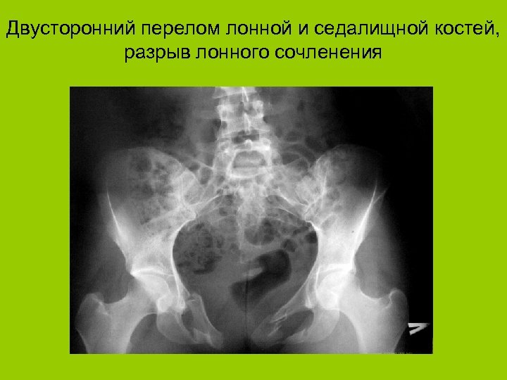 Двусторонний перелом лонной и седалищной костей, разрыв лонного сочленения 